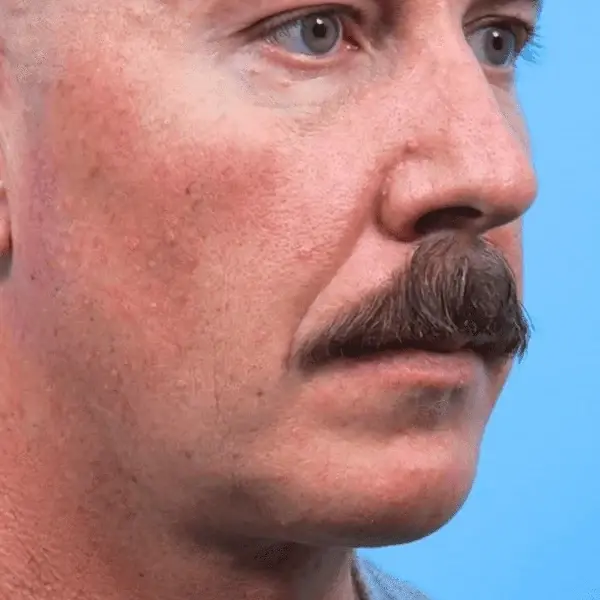 Ward MD Plastic Surgery facelift after — Salt Lake City, UT