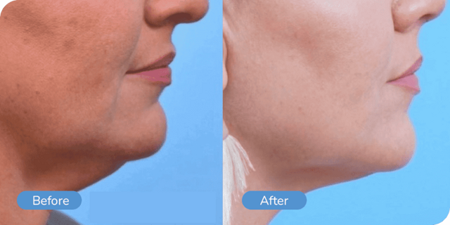 Rhinoplasty result at Ward MD Plastic Surgery in Salt Lake City, UT