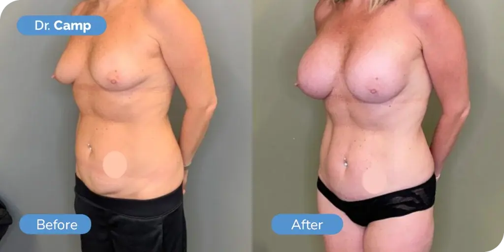 Ward MD Plastic Surgery mommy makeover result — Salt Lake City, UT