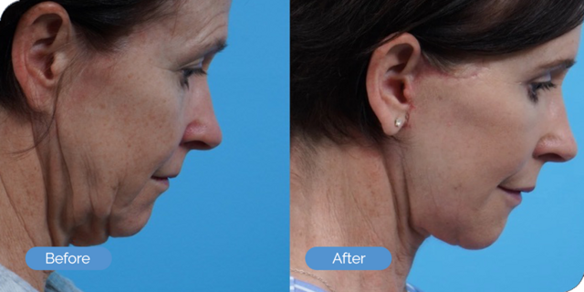 Deep Plane Facelift result at Ward MD Plastic Surgery in Salt Lake City, UT