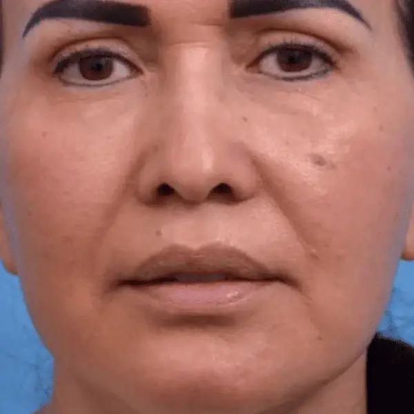 Ward MD Plastic Surgery facelift after — Salt Lake City, UT