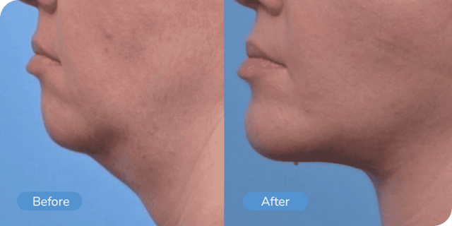 Rhinoplasty result at Ward MD Plastic Surgery in Salt Lake City, UT