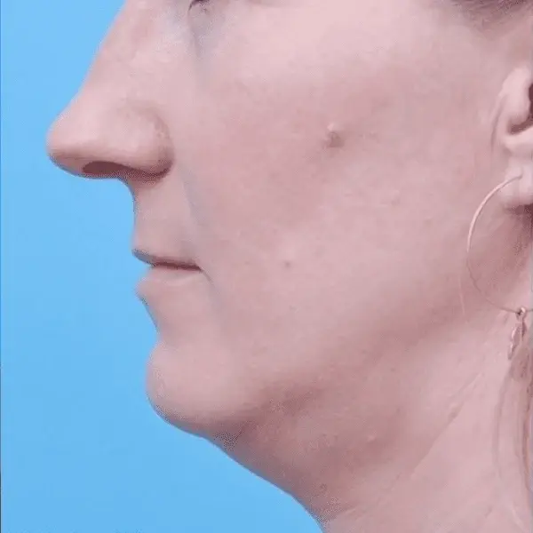 Neck Lift before at Ward MD Plastic Surgery in Salt Lake City, UT