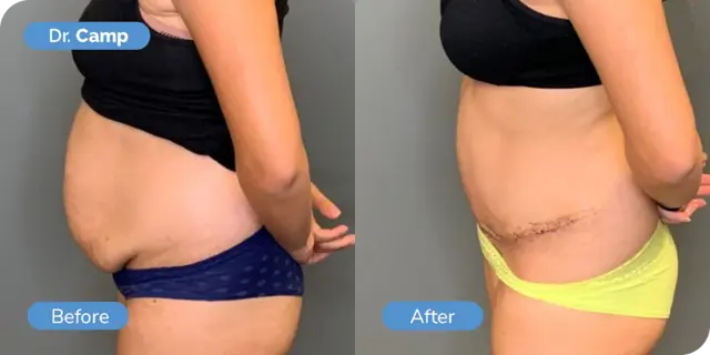 Tummy Tuck result at Ward MD Plastic Surgery in Salt Lake City, UT