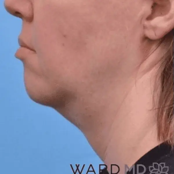 Neck Lift before at Ward MD Plastic Surgery in Salt Lake City, UT