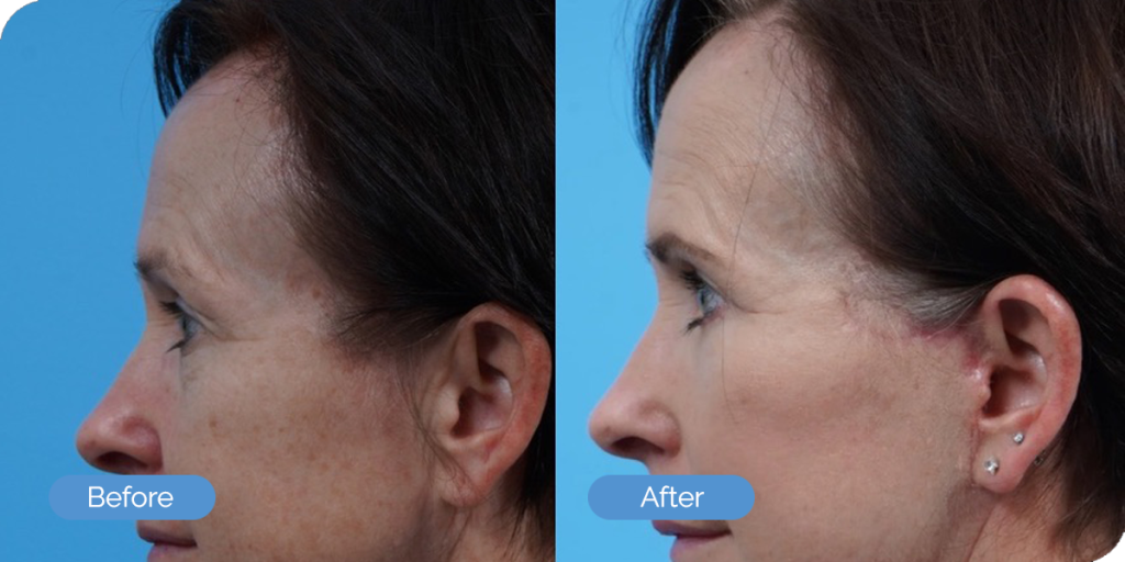 Ward MD Plastic Surgery blepharoplasty result — Salt Lake City, UT