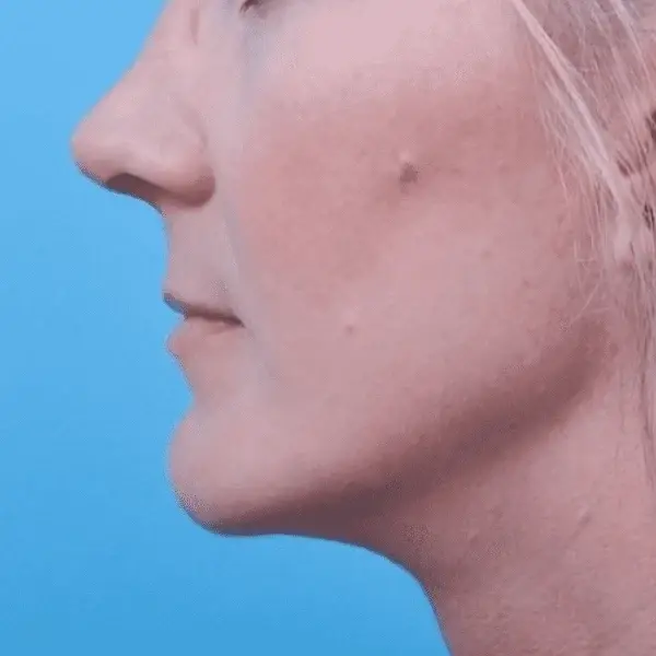 Ward MD Plastic Surgery neck lift after — Salt Lake City, UT