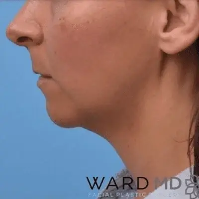 Neck Lift before at Ward MD Plastic Surgery in Salt Lake City, UT