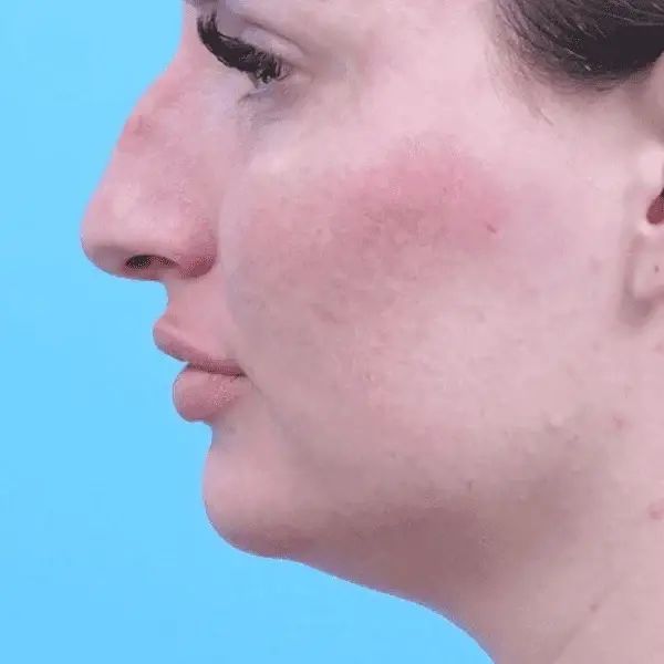 Ethnic Rhinoplasty before at Ward MD Plastic Surgery in Salt Lake City, UT