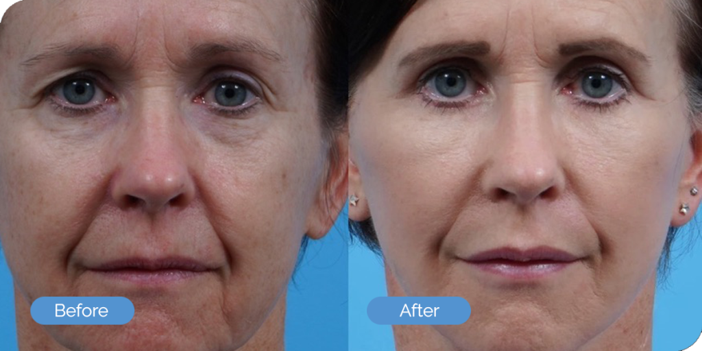 Ward MD Plastic Surgery blepharoplasty result — Salt Lake City, UT