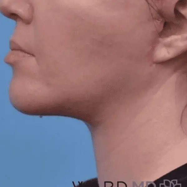 Ward MD Plastic Surgery neck lift after — Salt Lake City, UT