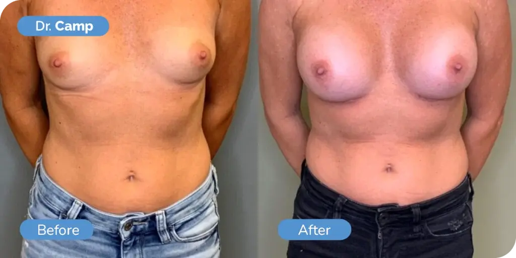 Ward MD Plastic Surgery breast augmentation result — Salt Lake City, UT