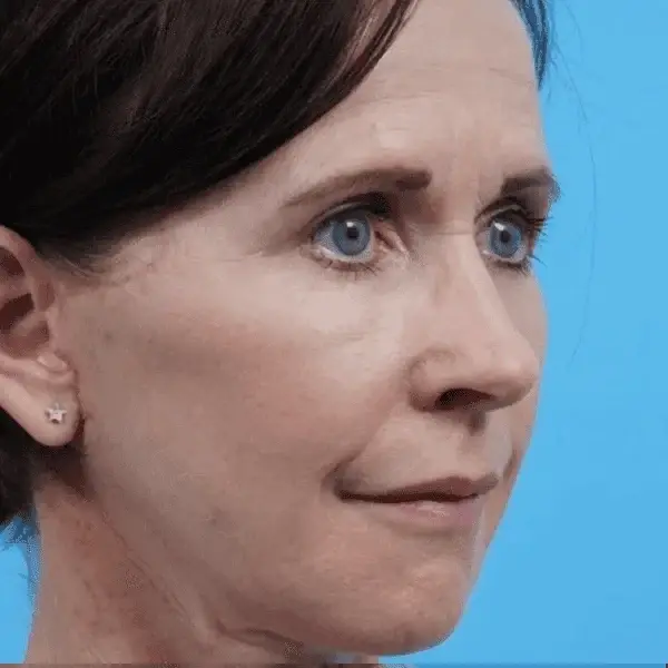 Ward MD Plastic Surgery facelift after — Salt Lake City, UT