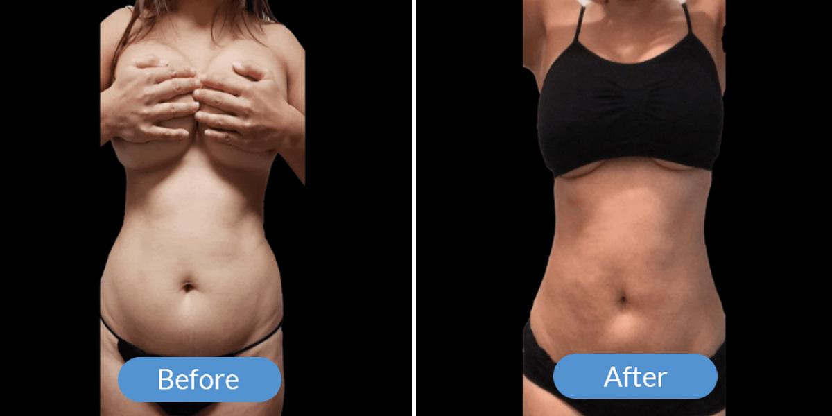 Ward MD Plastic Surgery liposuction result — Salt Lake City, UT