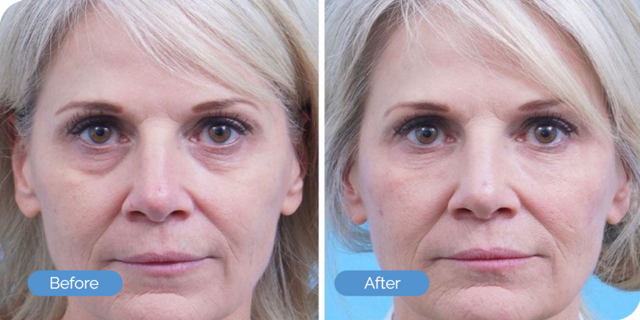 Blepharoplasty result at Ward MD Plastic Surgery in Salt Lake City, UT