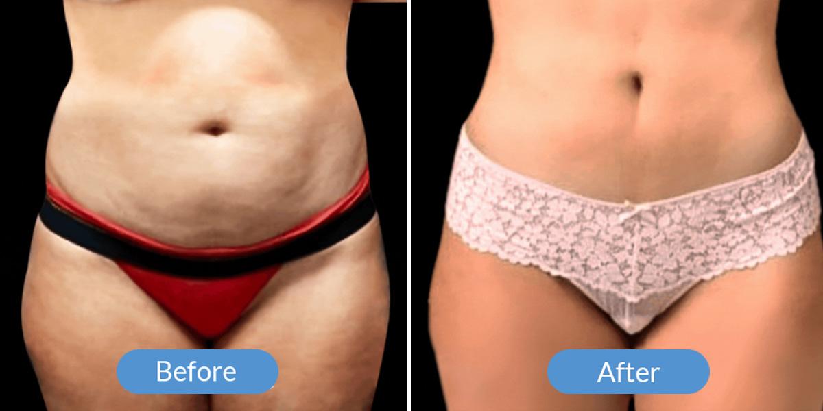 Ward MD Plastic Surgery liposuction result — Salt Lake City, UT