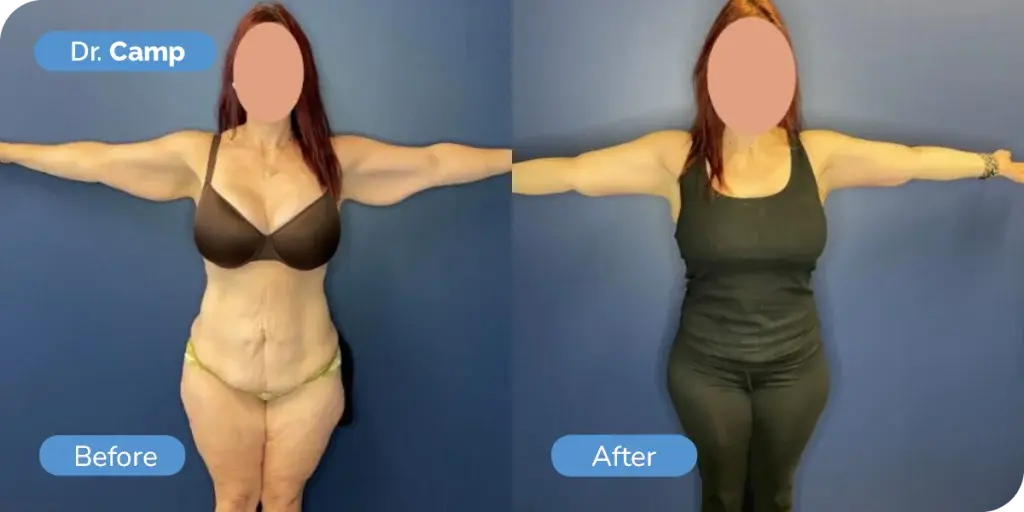 Ward MD Plastic Surgery arm lift result — Salt Lake City, UT