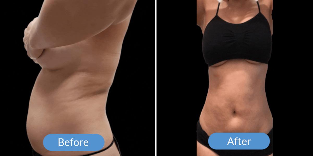 Ward MD Plastic Surgery liposuction result — Salt Lake City, UT