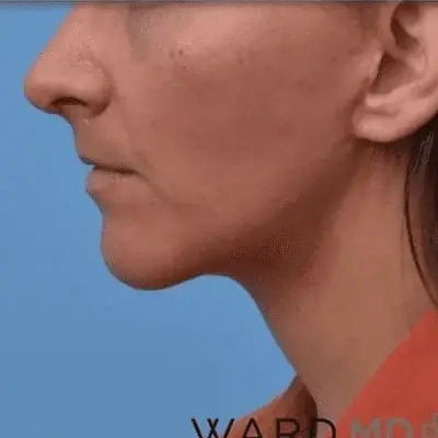 Neck Lift after at Ward MD Plastic Surgery in Salt Lake City, UT
