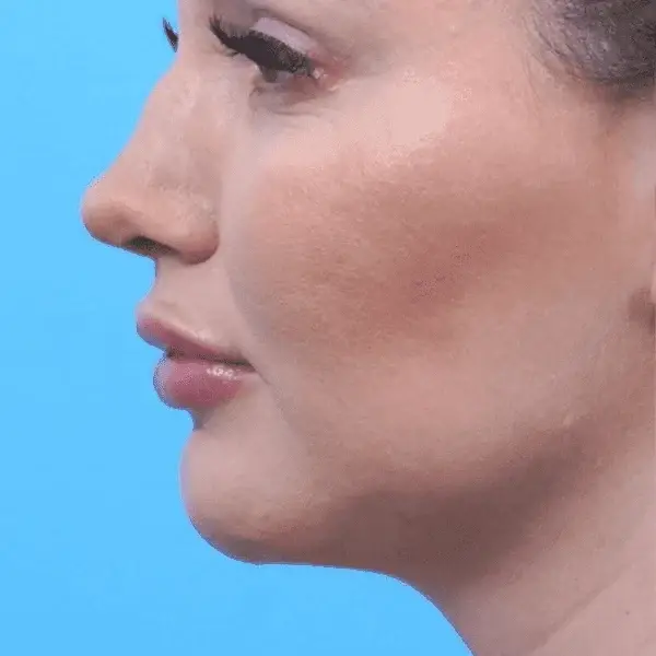 Ethnic Rhinoplasty after at Ward MD Plastic Surgery in Salt Lake City, UT