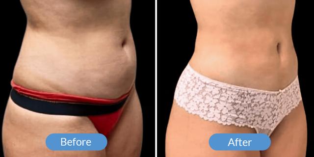Liposuction result at Ward MD Plastic Surgery in Salt Lake City, UT