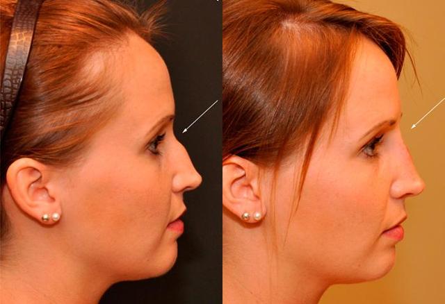 Rhinoplasty result at Donath Facial Plastic Surgery: Dr. Alexander Donath, MD, FACS in Cincinnati, OH