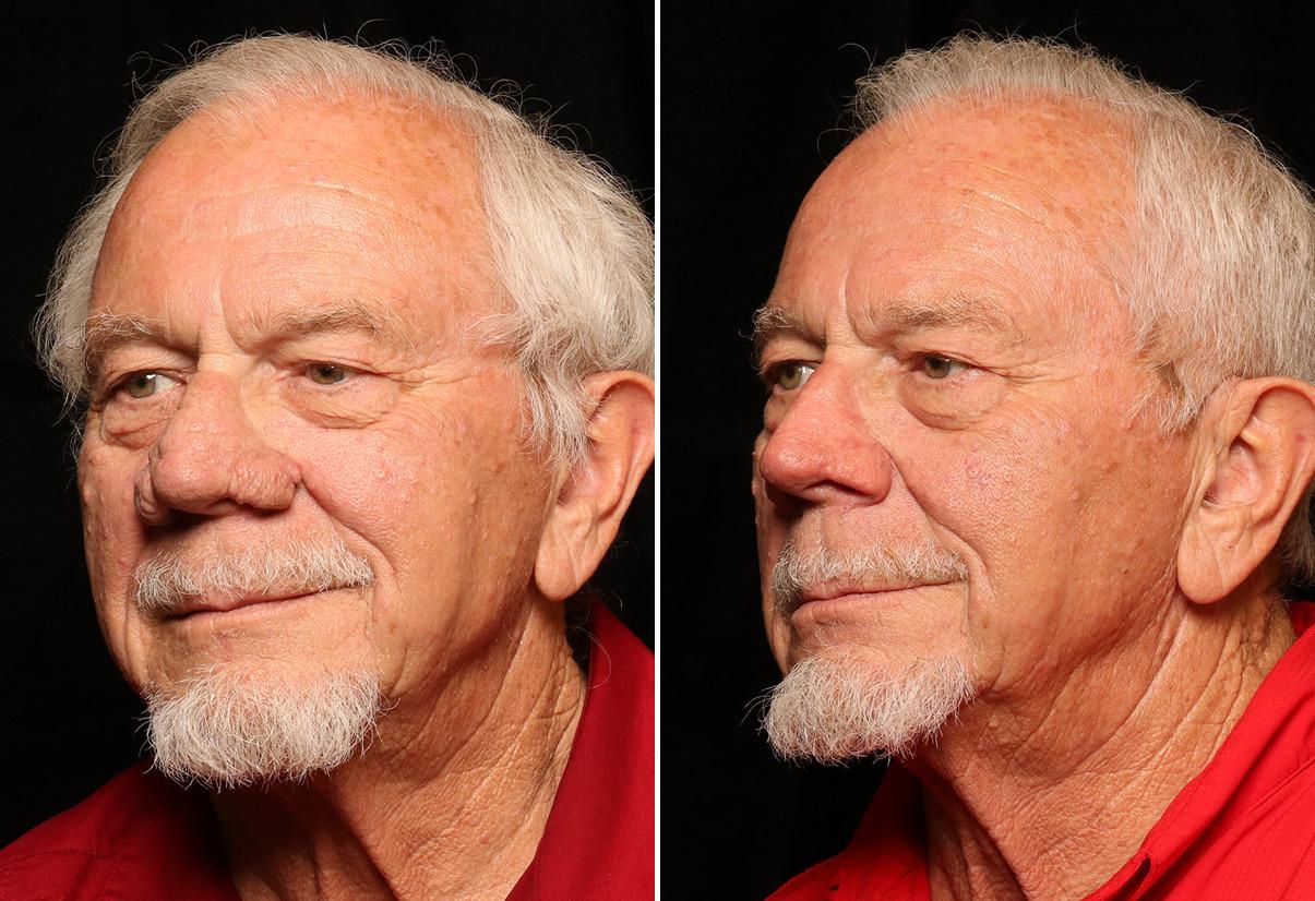 Donath Facial Plastic Surgery: Dr. Alexander Donath, MD, FACS result — Cincinnati, OH