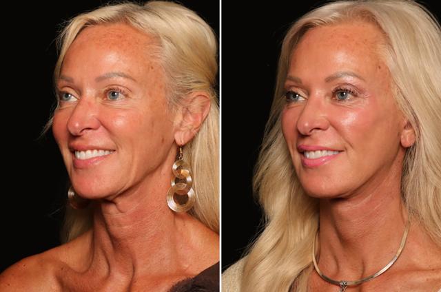 Laser Skin Resurfacing result at Donath Facial Plastic Surgery: Dr. Alexander Donath, MD, FACS in Cincinnati, OH