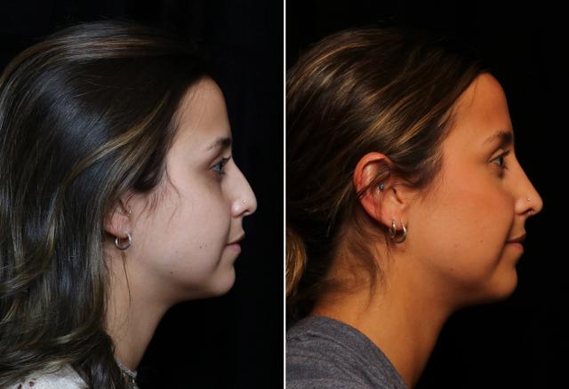 Rhinoplasty result at Donath Facial Plastic Surgery: Dr. Alexander Donath, MD, FACS in Cincinnati, OH