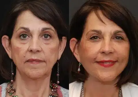 Facelift result at Donath Facial Plastic Surgery: Dr. Alexander Donath, MD, FACS in Cincinnati, OH