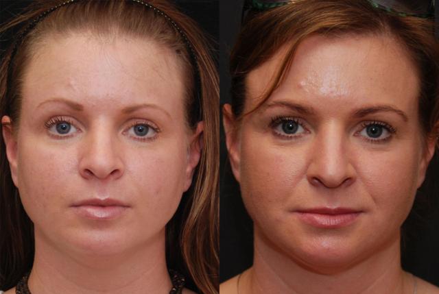 Neck Liposuction result at Donath Facial Plastic Surgery: Dr. Alexander Donath, MD, FACS in Cincinnati, OH