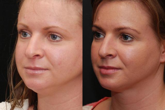 Neck Liposuction result at Donath Facial Plastic Surgery: Dr. Alexander Donath, MD, FACS in Cincinnati, OH