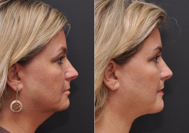 Neck Liposuction result at Donath Facial Plastic Surgery: Dr. Alexander Donath, MD, FACS in Cincinnati, OH