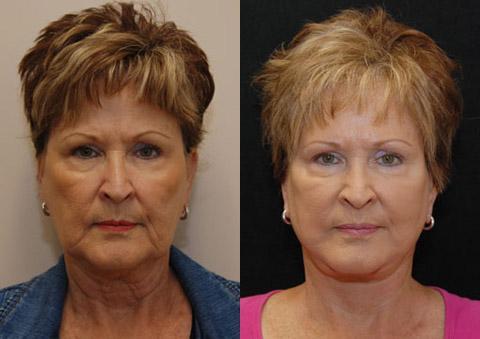 Facelift after at Donath Facial Plastic Surgery: Dr. Alexander Donath, MD, FACS in Cincinnati, OH