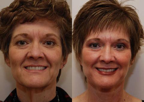 Facelift before at Donath Facial Plastic Surgery: Dr. Alexander Donath, MD, FACS in Cincinnati, OH