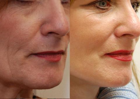 Laser Skin Resurfacing result at Donath Facial Plastic Surgery: Dr. Alexander Donath, MD, FACS in Cincinnati, OH