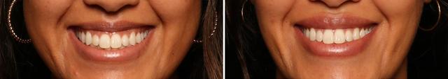 Lip Filler result at Donath Facial Plastic Surgery: Dr. Alexander Donath, MD, FACS in Cincinnati, OH