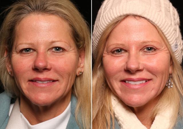 Blepharoplasty result at Donath Facial Plastic Surgery: Dr. Alexander Donath, MD, FACS in Cincinnati, OH