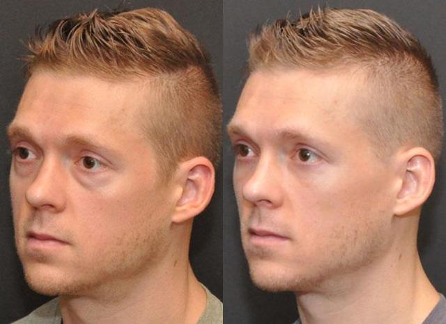Blepharoplasty result at Donath Facial Plastic Surgery: Dr. Alexander Donath, MD, FACS in Cincinnati, OH