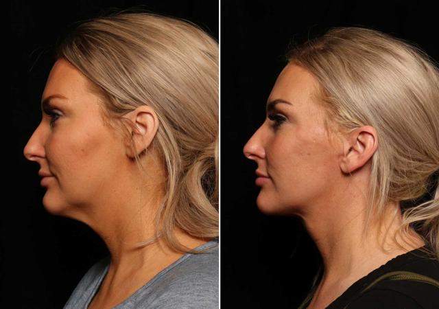 Neck Liposuction result at Donath Facial Plastic Surgery: Dr. Alexander Donath, MD, FACS in Cincinnati, OH