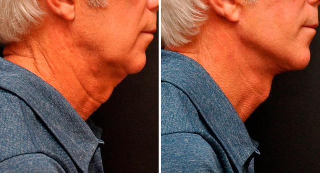 Facelift result at Donath Facial Plastic Surgery: Dr. Alexander Donath, MD, FACS in Cincinnati, OH