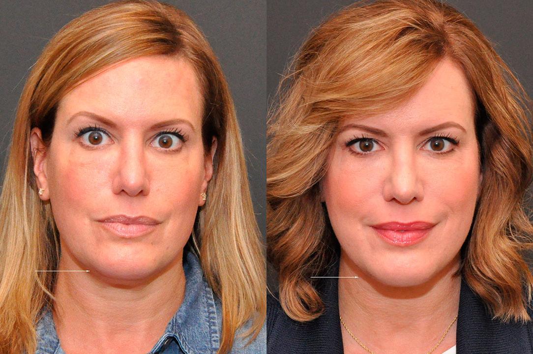 Donath Facial Plastic Surgery: Dr. Alexander Donath, MD, FACS result — Cincinnati, OH
