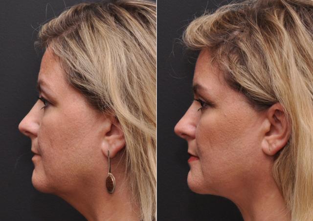 Neck Liposuction result at Donath Facial Plastic Surgery: Dr. Alexander Donath, MD, FACS in Cincinnati, OH