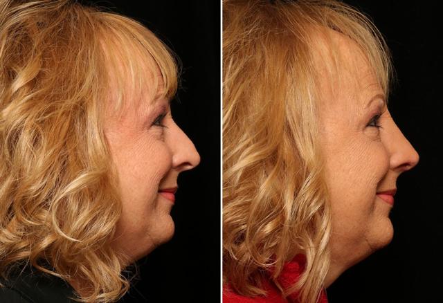 Rhinoplasty result at Donath Facial Plastic Surgery: Dr. Alexander Donath, MD, FACS in Cincinnati, OH