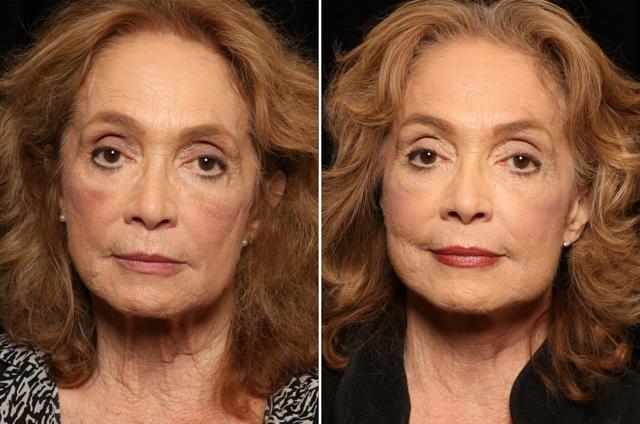 Neck Lift result at Donath Facial Plastic Surgery: Dr. Alexander Donath, MD, FACS in Cincinnati, OH