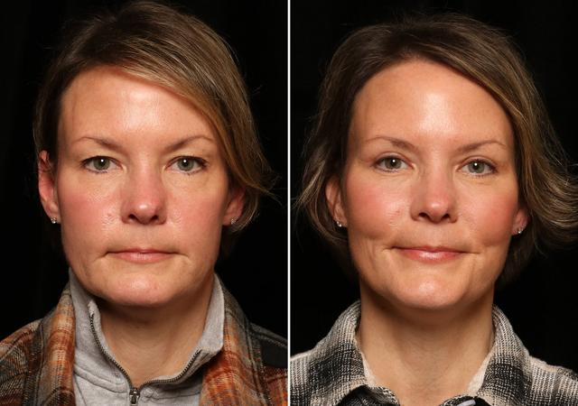 Blepharoplasty result at Donath Facial Plastic Surgery: Dr. Alexander Donath, MD, FACS in Cincinnati, OH