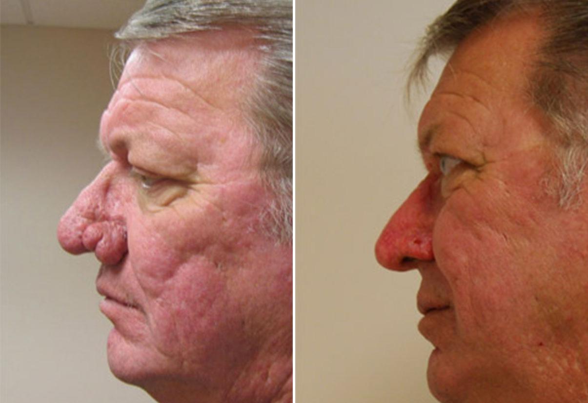 Donath Facial Plastic Surgery: Dr. Alexander Donath, MD, FACS result — Cincinnati, OH