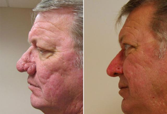 Functional Rhinoplasty result at Donath Facial Plastic Surgery: Dr. Alexander Donath, MD, FACS in Cincinnati, OH