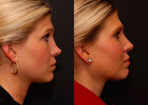 Rhinoplasty result at Donath Facial Plastic Surgery: Dr. Alexander Donath, MD, FACS in Cincinnati, OH