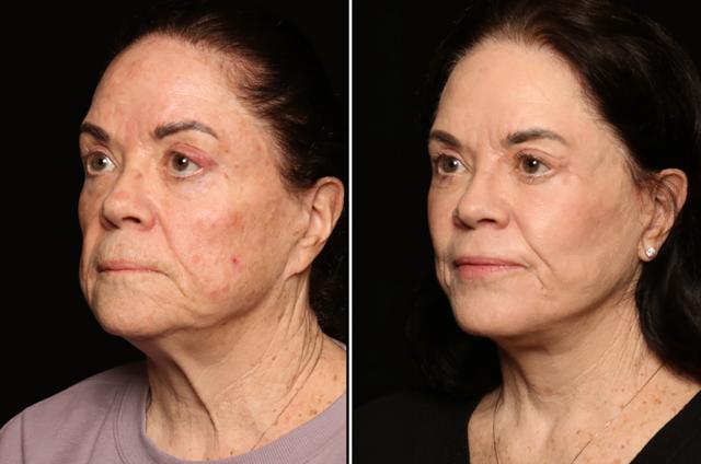 Laser Skin Resurfacing result at Donath Facial Plastic Surgery: Dr. Alexander Donath, MD, FACS in Cincinnati, OH